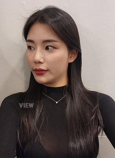 Facial Fat Grafting ,Fat Grafting Areas ,Facial Fat Enhancement