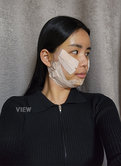 Day 3 of Fat Grafting Review, Post-Operative Care ,Post-Surgery Precautions