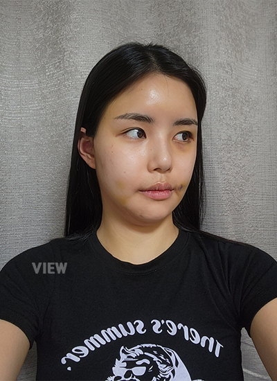 Day 7 Facial Contouring Surgery Review, 