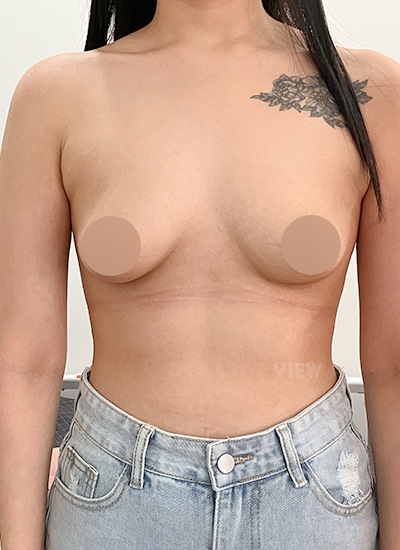 Motiva Reviews / Breast Surgery Clinics / Breast Surgery Hospital / Breast Surgery in Korea