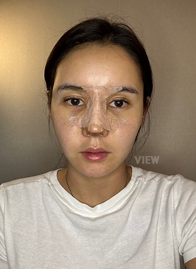 Thread Lift, Fat Grafting, Review at View Plastic Surgery