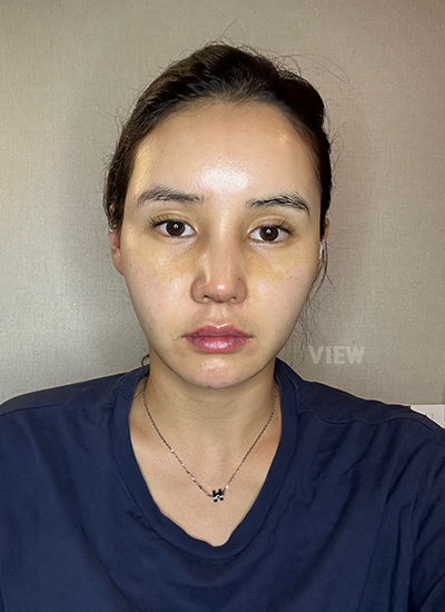 Thread Lift, Fat Grafting, Review at View Plastic Surgery