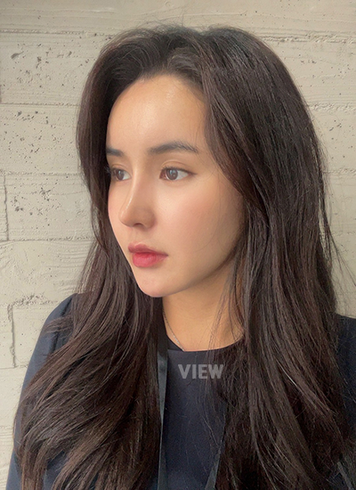 Thread Lift, Fat Grafting, Review at View Plastic Surgery