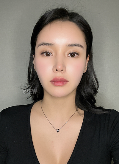 Thread Lift, Fat Grafting, Review at View Plastic Surgery