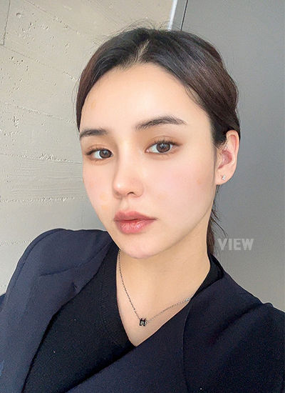 Thread Lift, Fat Grafting, Review at View Plastic Surgery