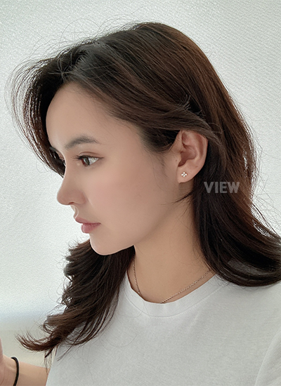 Thread Lift, Fat Grafting, Review at View Plastic Surgery