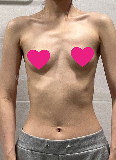 Review at View Plastic Surgery, Plastic Surgery in Korea, View Clinic, Korea Clinic