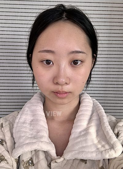 View Plastic Surgery Review, Facial Contouring, Korean Plastic Surgery Clinic Consultation, Cheekbone Reduction Price, Jawline Reduction Price