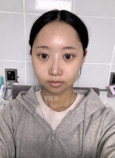 View Plastic Surgery Review, Facial Contouring, Korean Plastic Surgery Clinic Consultation, Cheekbone Reduction Price, Jawline Reduction Price 