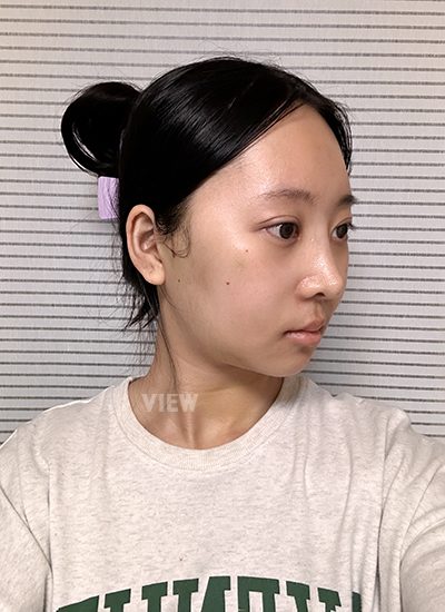 Review at View Plastic Surgery, Plastic Surgery in Korea, View Clinic, Korea Clinic