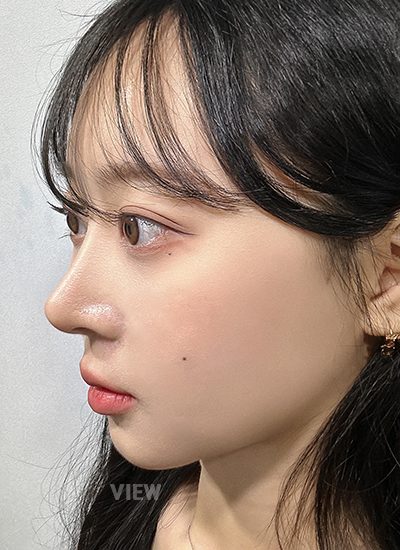 Review at View Plastic Surgery, Plastic Surgery in Korea, View Clinic, Korea Clinic 