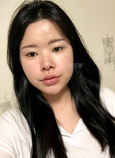 Rhinoplasty, Nose Job, Fat Grafting, Liposuction