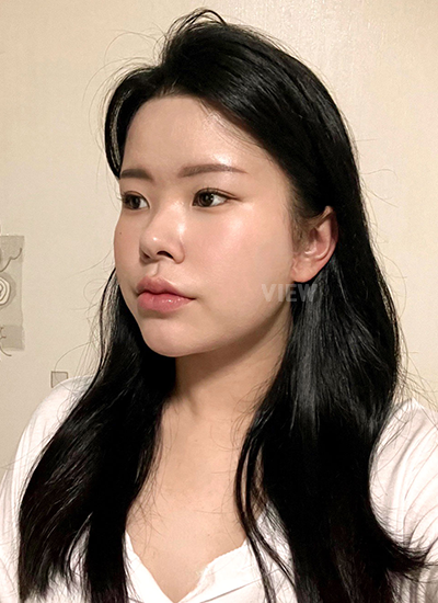 Review at View Plastic Surgery, Plastic Surgery in Korea, View Clinic, Korea Clinic 