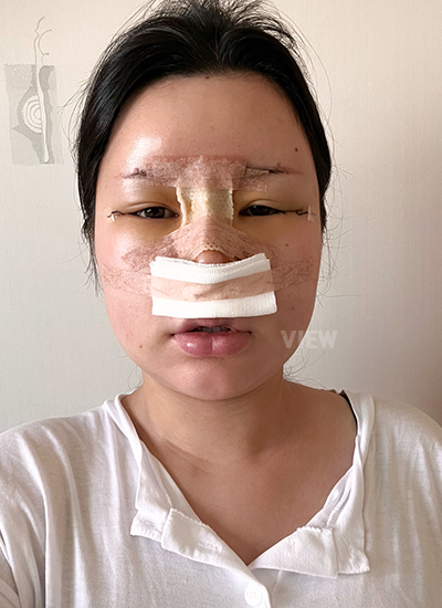 Review at View Plastic Surgery, Plastic Surgery in Korea, View Clinic, Korea Clinic 