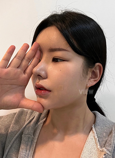 Review at View Plastic Surgery, Plastic Surgery in Korea, View Clinic, Korea Clinic 