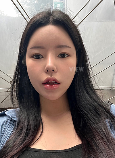 Rhinoplasty, Nose Job, Fat Grafting, Liposuction 