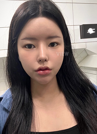 Review at View Plastic Surgery, Plastic Surgery in Korea, View Clinic, Korea Clinic 