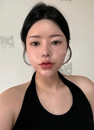 Rhinoplasty, Nose Job, Fat Grafting, Liposuction 