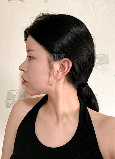 Rhinoplasty, Nose Job, Fat Grafting, Liposuction 