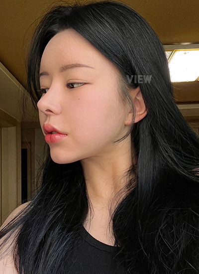 Review at View Plastic Surgery, Plastic Surgery in Korea, View Clinic, Korea Clinic 