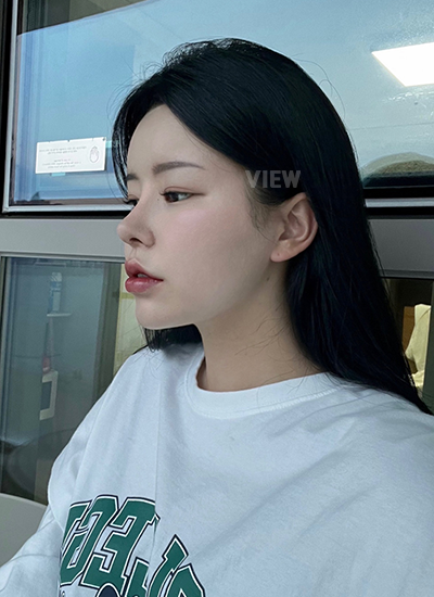 Rhinoplasty, Nose Job, Fat Grafting, Liposuction 