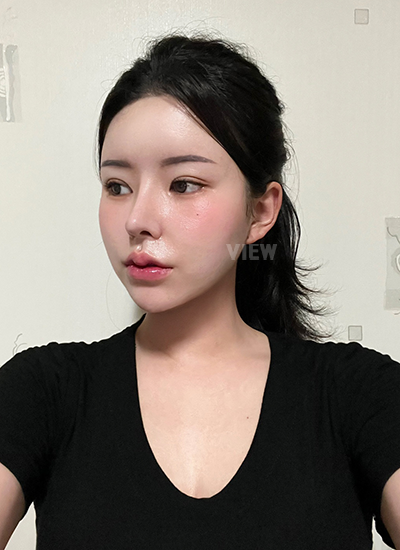 Rhinoplasty, Nose Job, Fat Grafting, Liposuction 