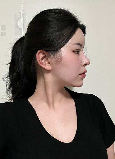 Review at View Plastic Surgery, Plastic Surgery in Korea, View Clinic, Korea Clinic 