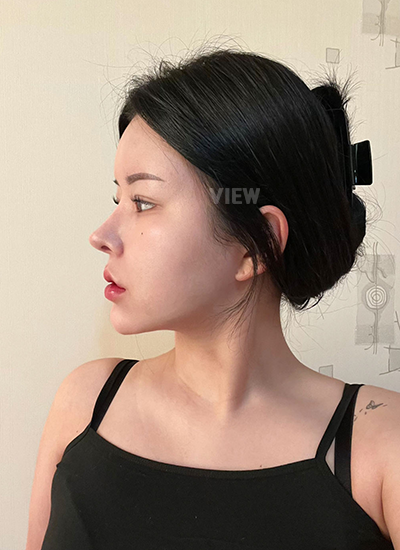 Rhinoplasty, Nose Job, Fat Grafting, Liposuction 