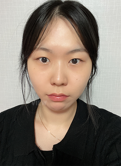 Double eyelid surgery, Non-incisional eyelid surgery