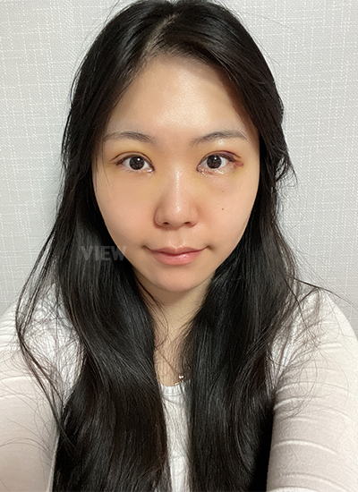 Review at View Plastic Surgery, Plastic Surgery in Korea, View Clinic, Korea Clinic 