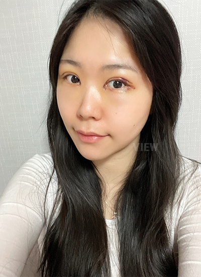 Double eyelid surgery, Non-incisional eyelid surgery