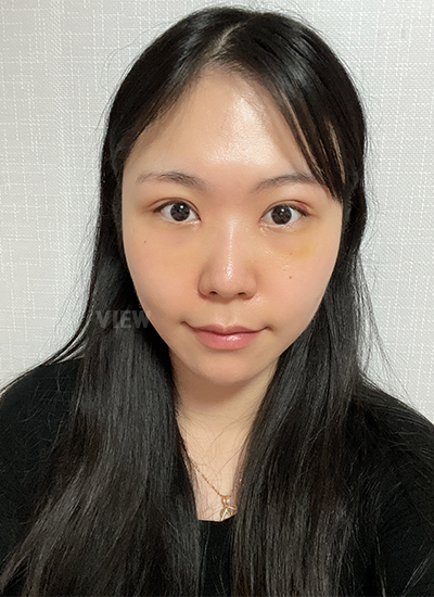 Double eyelid surgery, Non-incisional eyelid surgery 