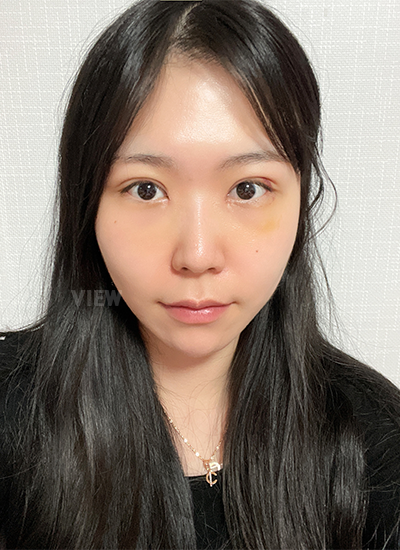 Review at View Plastic Surgery, Plastic Surgery in Korea, View Clinic, Korea Clinic 