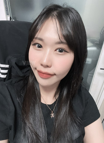 Double eyelid surgery, Non-incisional eyelid surgery 