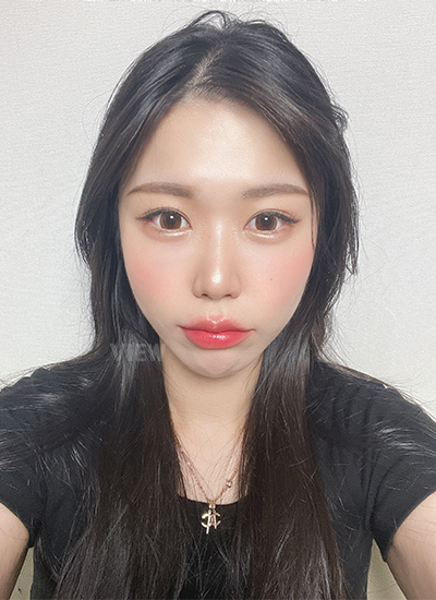 Review at View Plastic Surgery, Plastic Surgery in Korea, View Clinic, Korea Clinic 