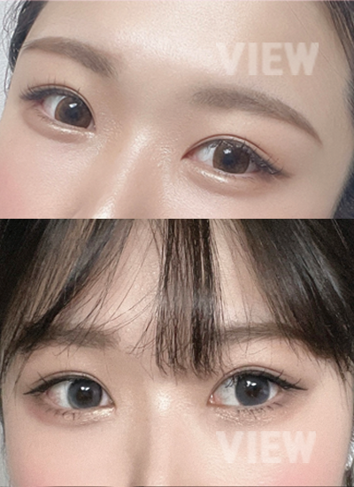Double eyelid surgery, Non-incisional eyelid surgery 