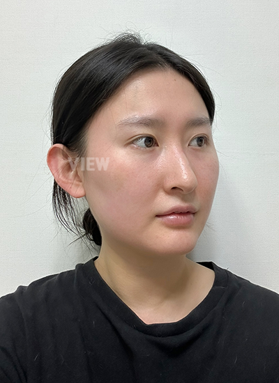 View Plastic Surgery Review, Facial Contouring, Korean Plastic Surgery Clinic Consultation, Cheekbone Reduction Price, Jawline Reduction Price