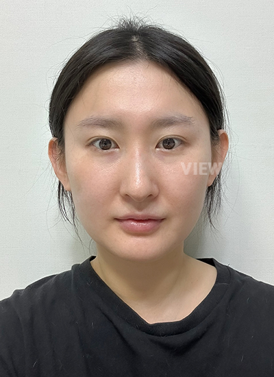 Review at View Plastic Surgery, Plastic Surgery in Korea, View Clinic, Korea Clinic 