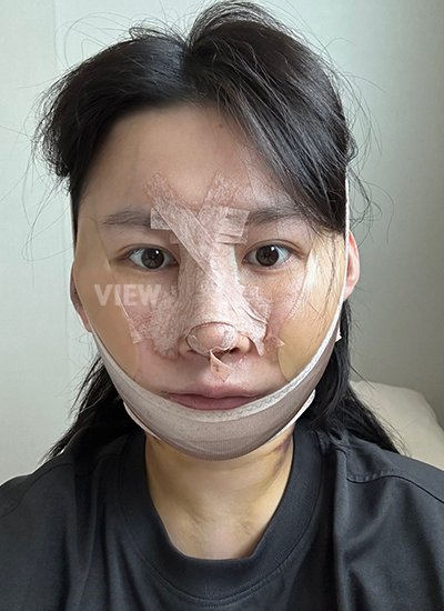 Rhinoplasty, Nose Job