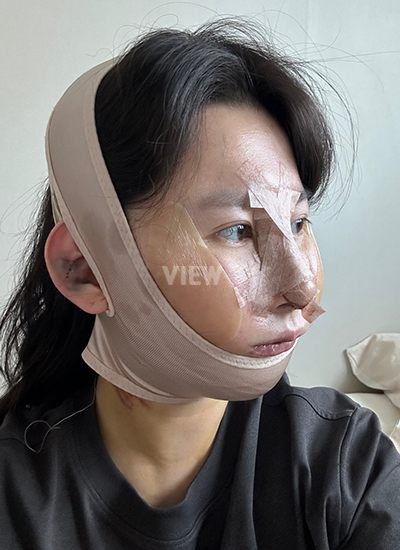 View Plastic Surgery Review, Facial Contouring, Korean Plastic Surgery Clinic Consultation, Cheekbone Reduction Price, Jawline Reduction Price