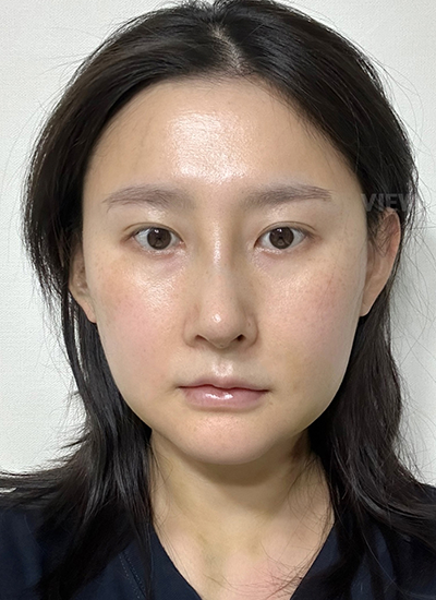 Review at View Plastic Surgery, Plastic Surgery in Korea, View Clinic, Korea Clinic