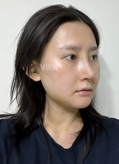 Rhinoplasty, Nose Job