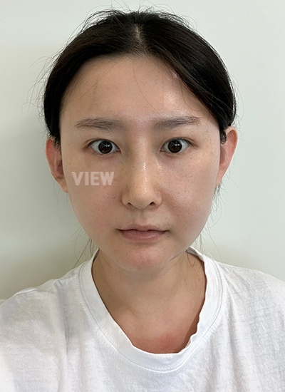View Plastic Surgery Review, Facial Contouring, Korean Plastic Surgery Clinic Consultation, Cheekbone Reduction Price, Jawline Reduction Price 