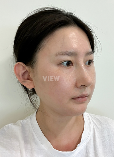 View Plastic Surgery Review, Facial Contouring, Korean Plastic Surgery Clinic Consultation, Cheekbone Reduction Price, Jawline Reduction Price 