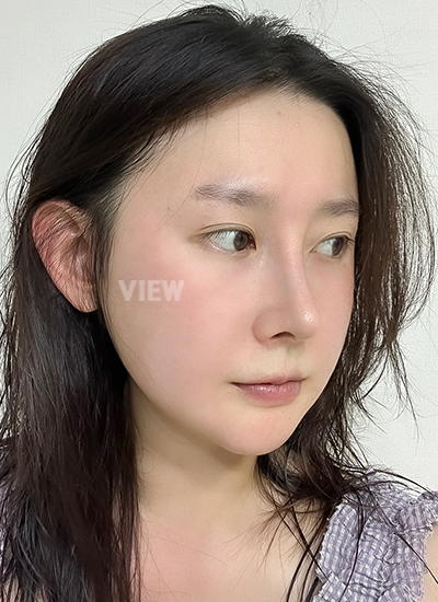 Review at View Plastic Surgery, Plastic Surgery in Korea, View Clinic, Korea Clinic 