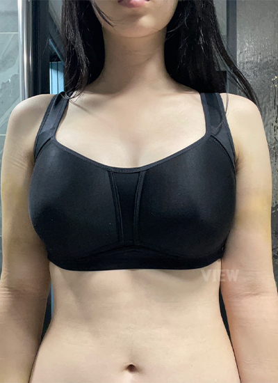 Breast Augmentation, Breast Enlargement Surgery, Breast surgery, Breast augmentation surgery, Mentor review, Breast surgery clinic, Mentor implants, Mentor Xtra Smooth, Breast implants 