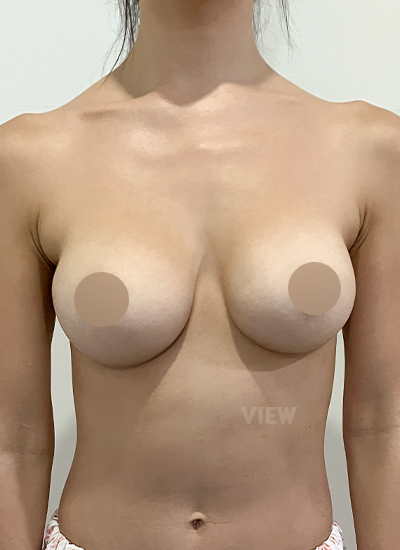 Review at View Plastic Surgery, Plastic Surgery in Korea, View Clinic, Korea Clinic 