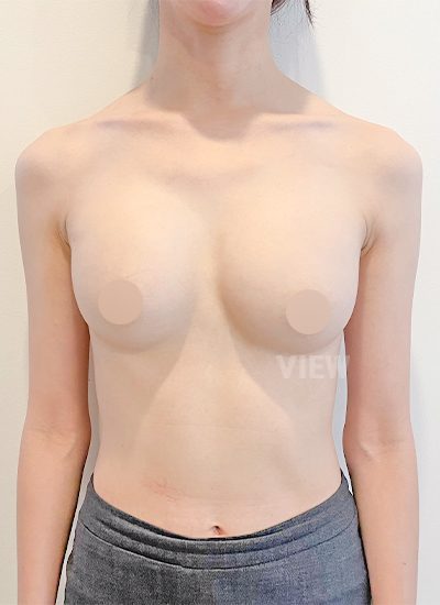 Breast Augmentation, Breast Enlargement Surgery, Breast surgery, Breast augmentation surgery, Mentor review, Breast surgery clinic, Mentor implants, Mentor Xtra Smooth, Breast implants