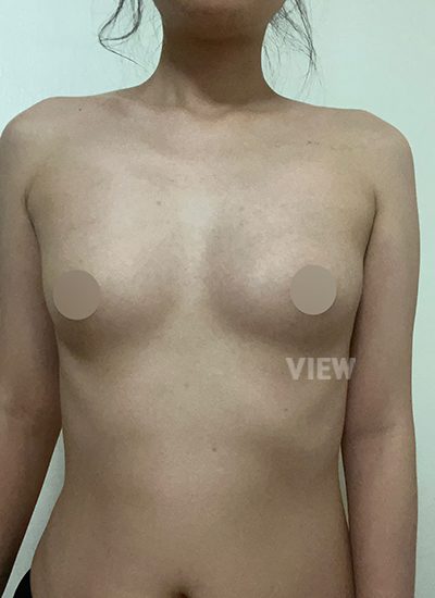 Review at View Plastic Surgery, Plastic Surgery in Korea, View Clinic, Korea Clinic