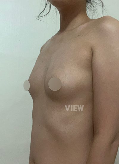 Review at View Plastic Surgery, Plastic Surgery in Korea, View Clinic, Korea Clinic